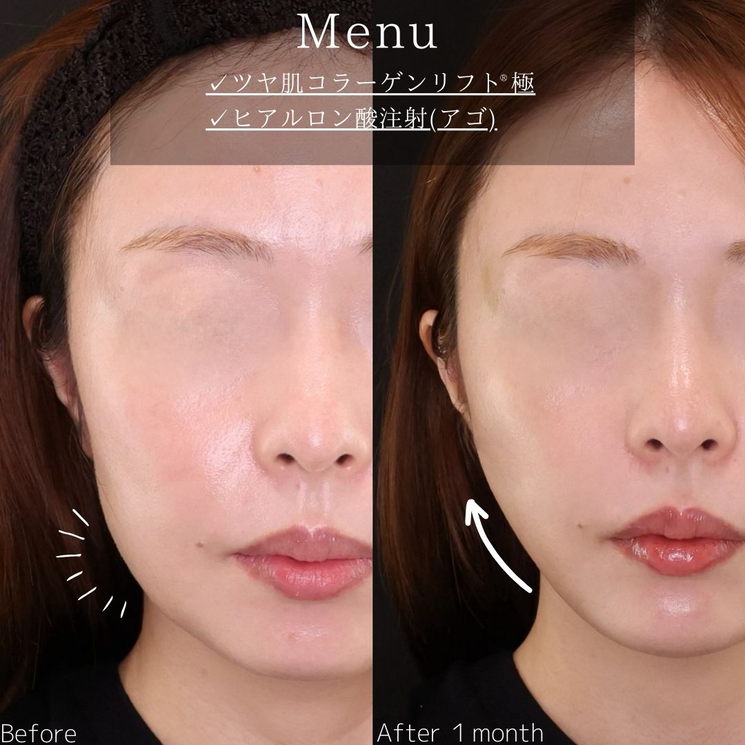 TAC式 ツヤ肌コラーゲンリフト®/鼻のヒアルロン酸注射の症例写真 施術前後 