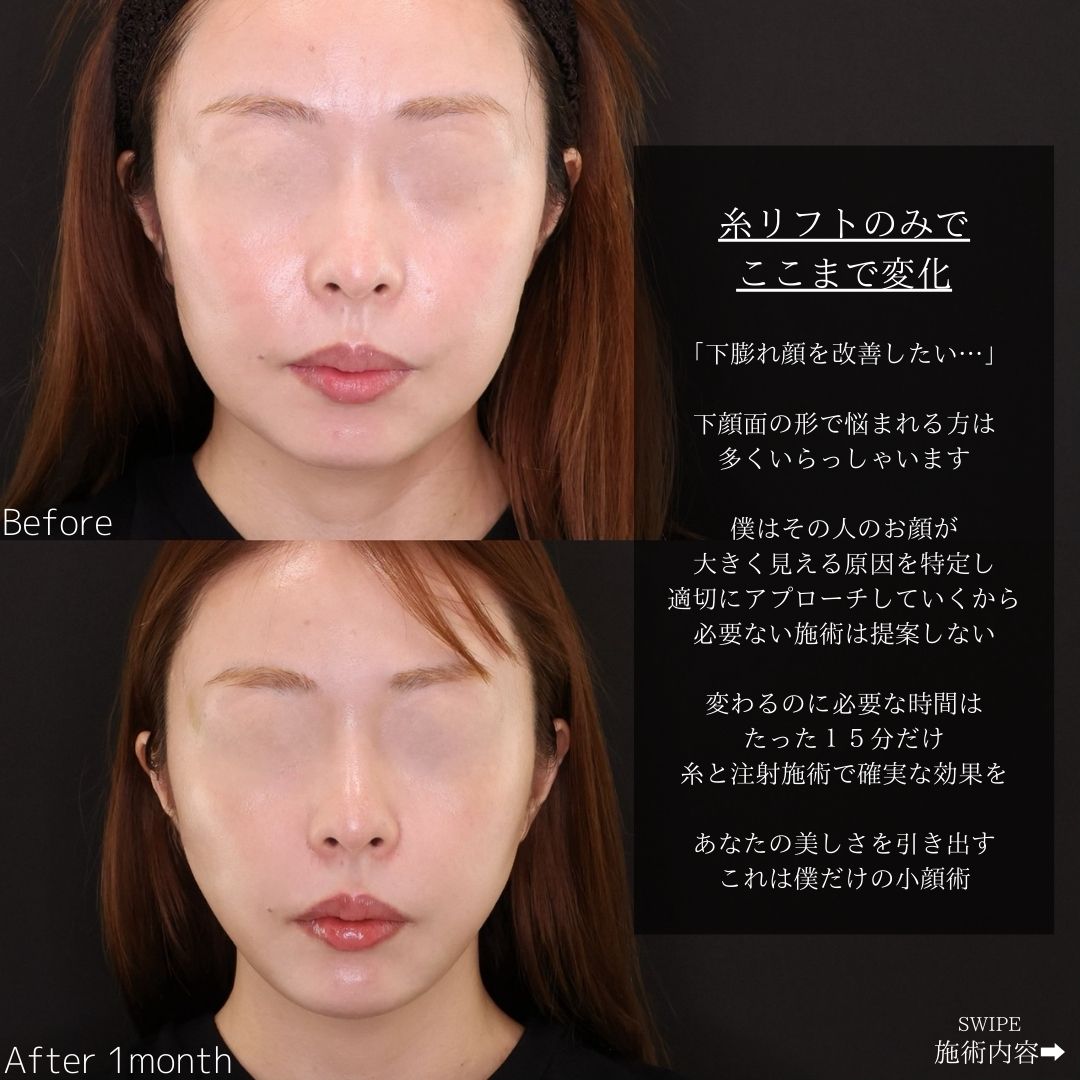 TAC式 ツヤ肌コラーゲンリフト®/鼻のヒアルロン酸注射の症例写真 施術前後 