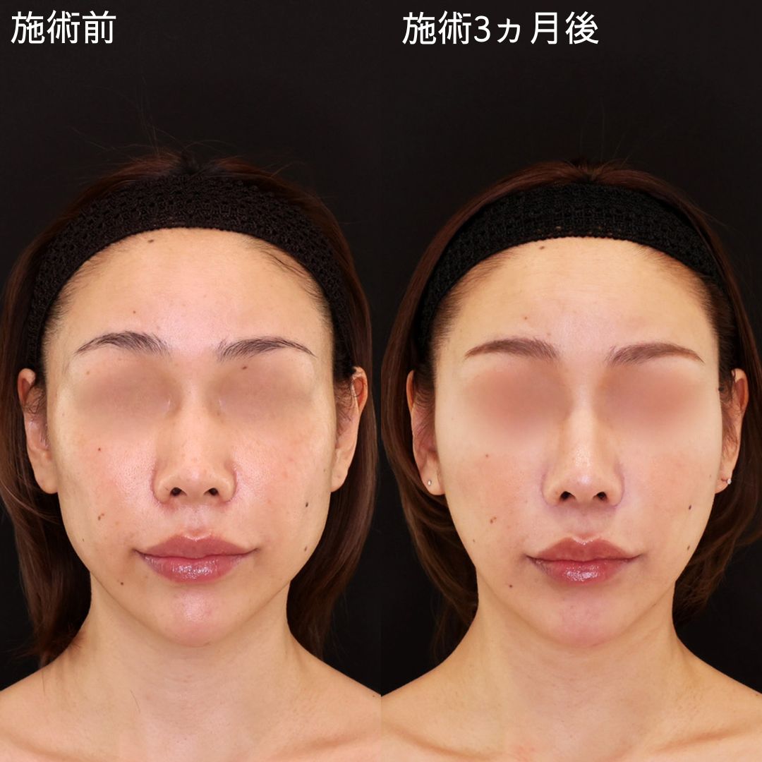 女性らしさを高める小顔術【糸リフト】