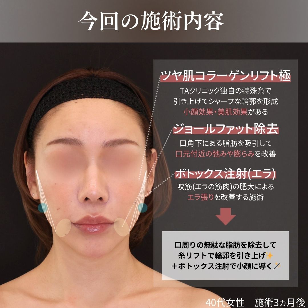 TAC式 ツヤ肌コラーゲンリフト®/ジョールファット除去/エラボトックス注射の症例写真 施術前後