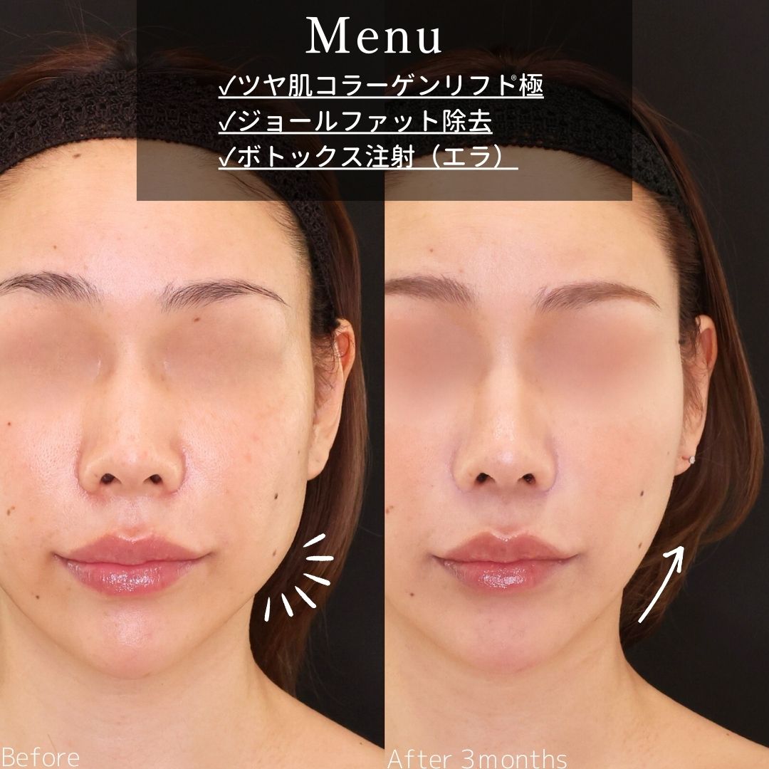 TAC式 ツヤ肌コラーゲンリフト®/ジョールファット除去/エラボトックス注射の症例写真 施術前後