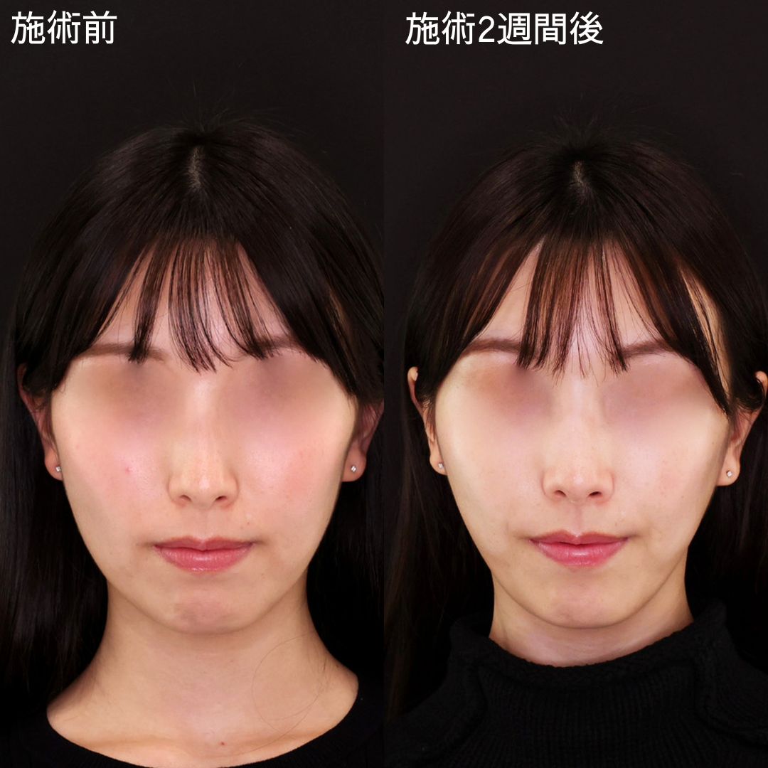 ナチュラルに輪郭を改善！即日小顔術【糸リフト】