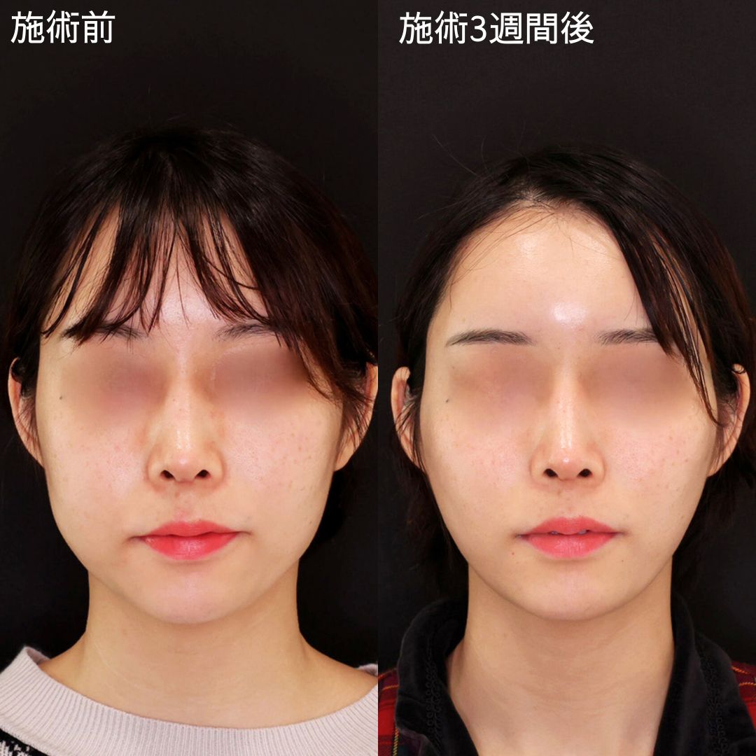 糸リフトで輪郭の弛みを整えてスッキリ!卵型の小顔に導く