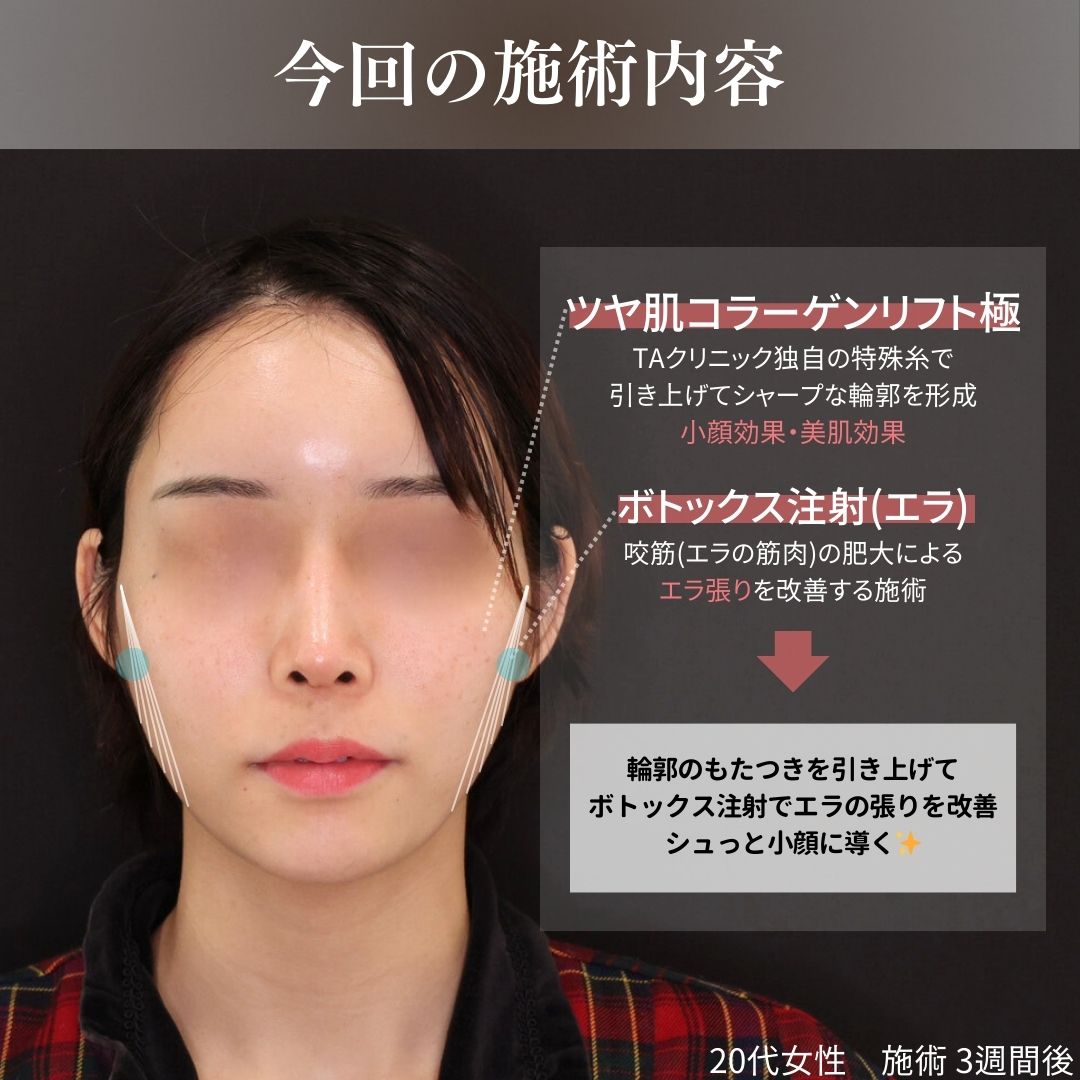 TAC式 ツヤ肌コラーゲンリフト®/エラボトックス注射の症例写真 施術前後 
