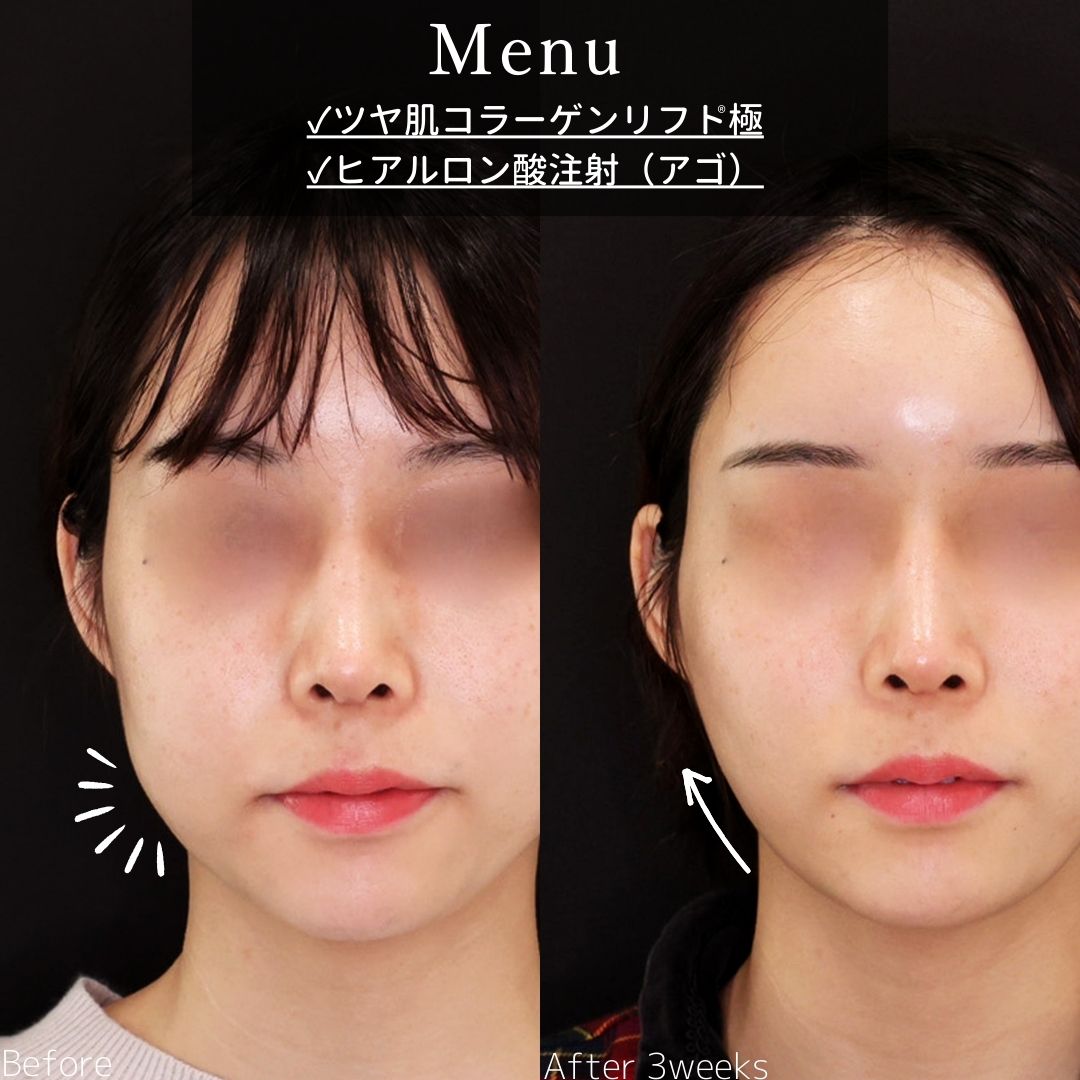 TAC式 ツヤ肌コラーゲンリフト®/エラボトックス注射の症例写真 施術前後 