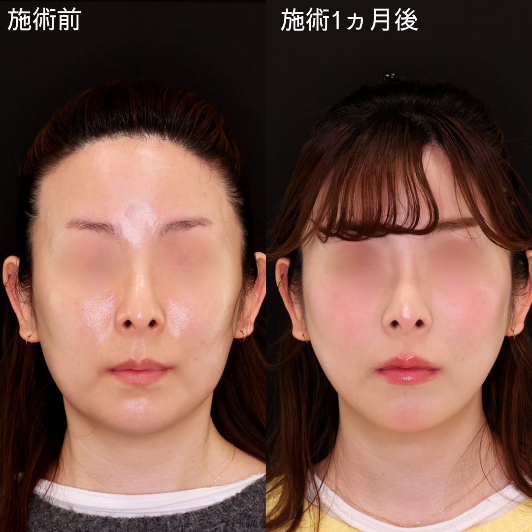 可愛くなったと褒められる！垢抜け小顔術【糸リフト×脂肪除去】