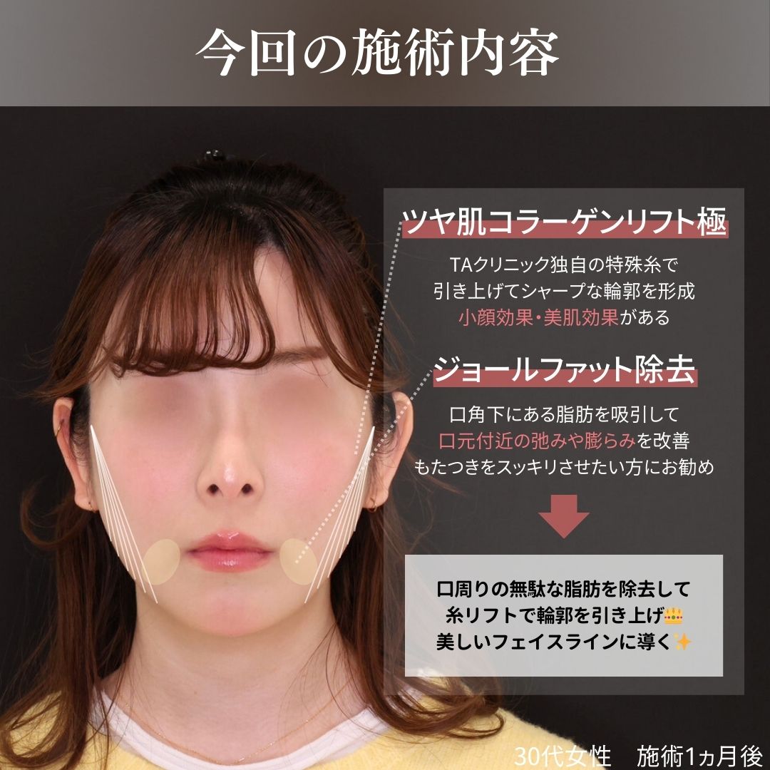 TAC式 ツヤ肌コラーゲンリフト®/ジョールファット除去の症例写真 施術前後 