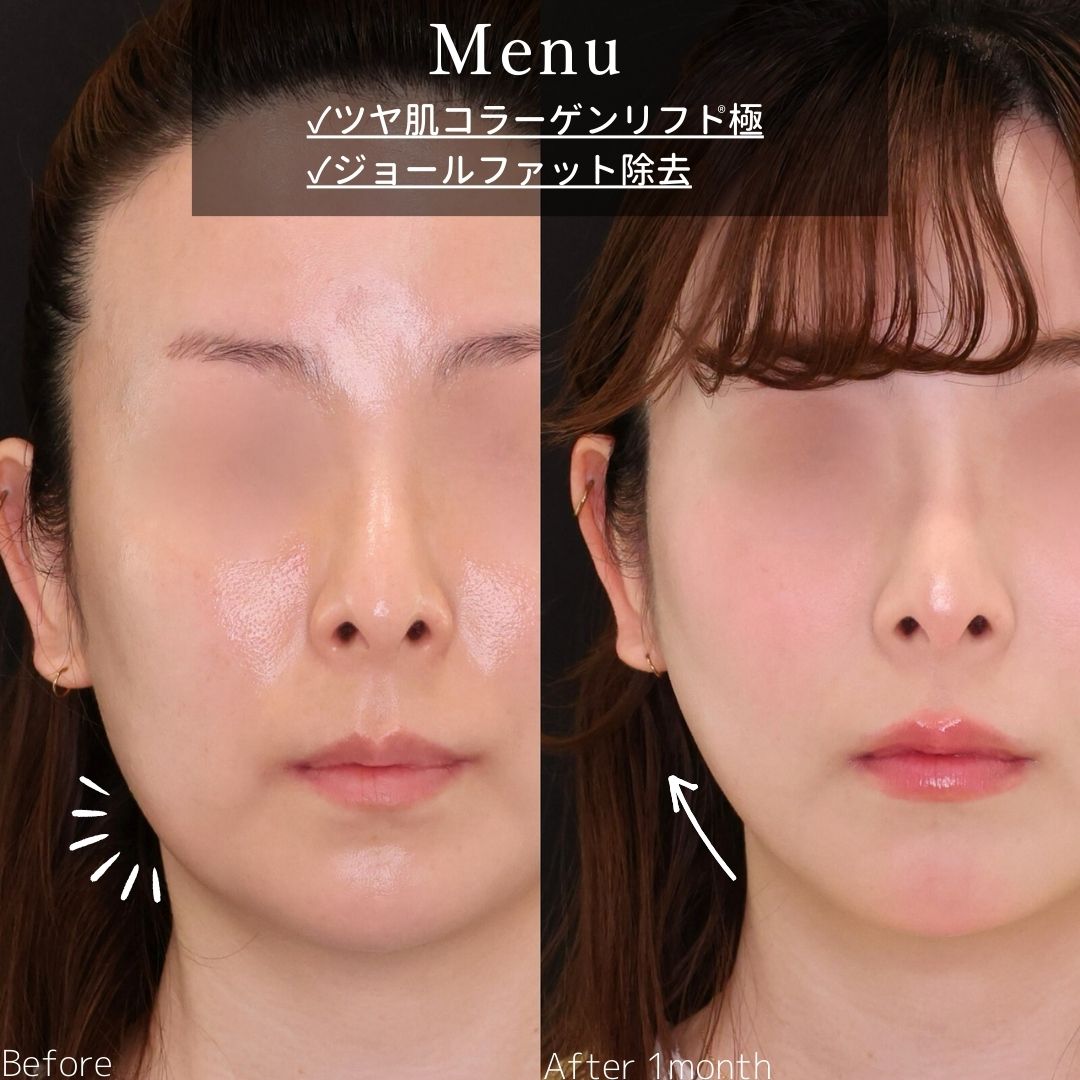 TAC式 ツヤ肌コラーゲンリフト®/ジョールファット除去の症例写真 施術前後 