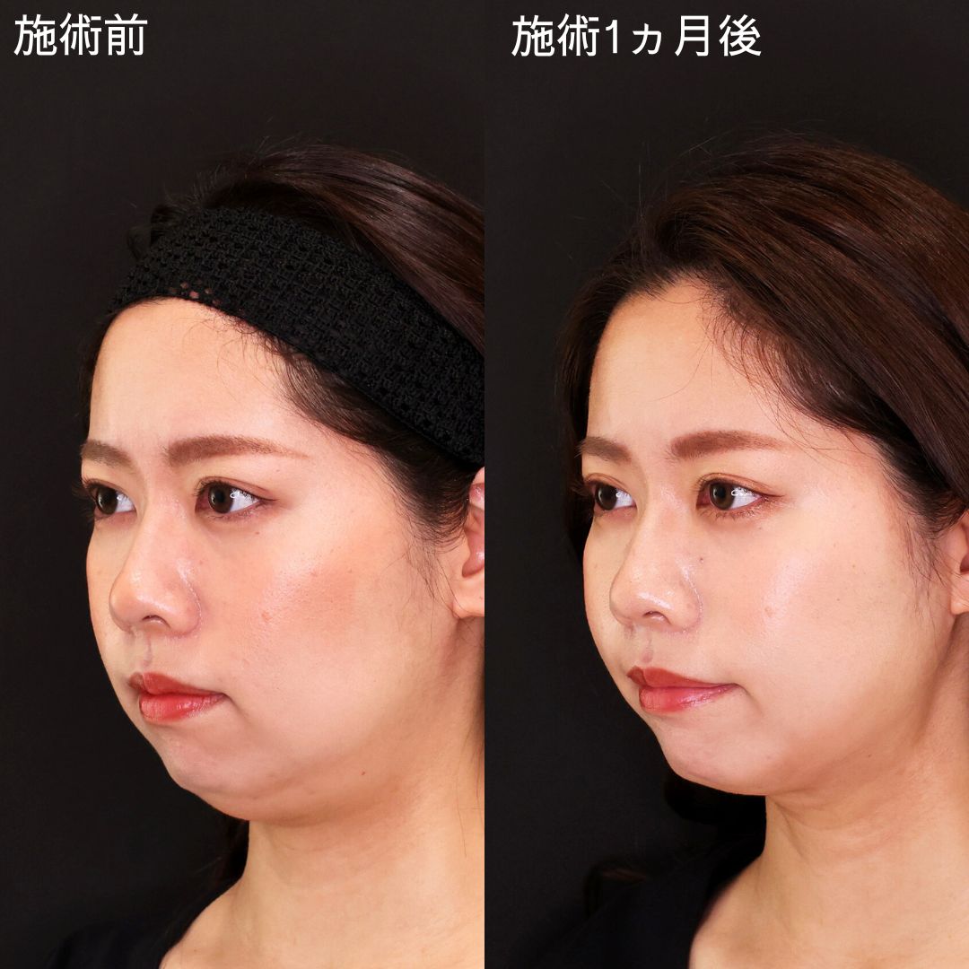 印象激変！人生を変えるDr.石橋の小顔術【糸リフト×脂肪吸引】