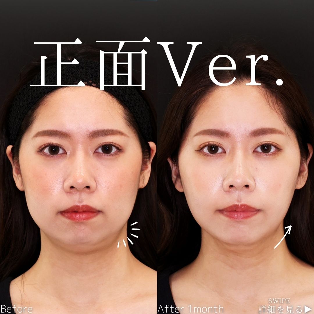 TAC式 ツヤ肌コラーゲンリフト®/顔の脂肪吸引/ジョールファット除去の症例写真 施術前後 