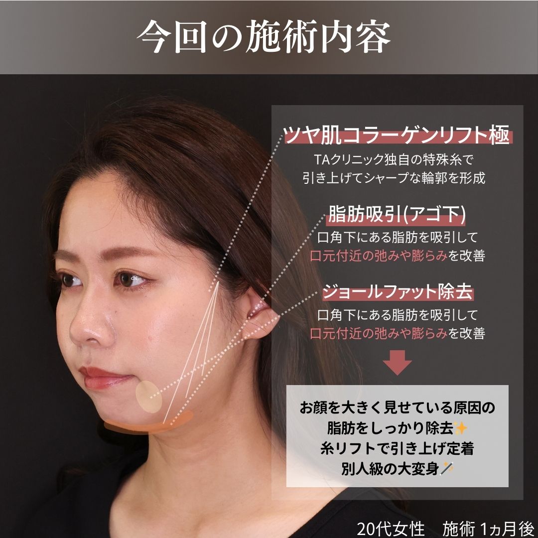 TAC式 ツヤ肌コラーゲンリフト®/顔の脂肪吸引/ジョールファット除去の症例写真 施術前後 