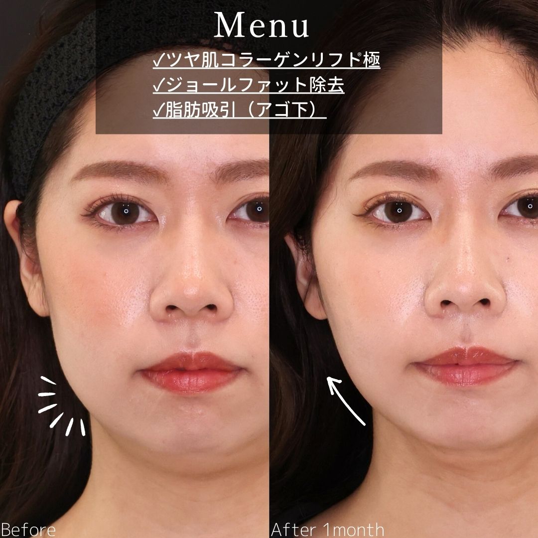 TAC式 ツヤ肌コラーゲンリフト®/顔の脂肪吸引/ジョールファット除去の症例写真 施術前後 