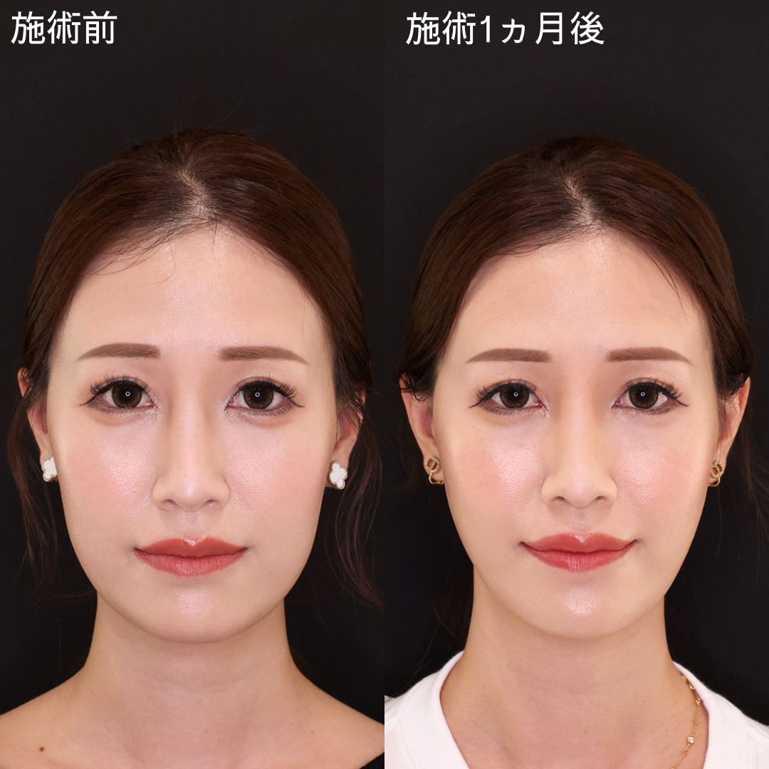 糸リフトのみで確実に垢抜ける。女優級