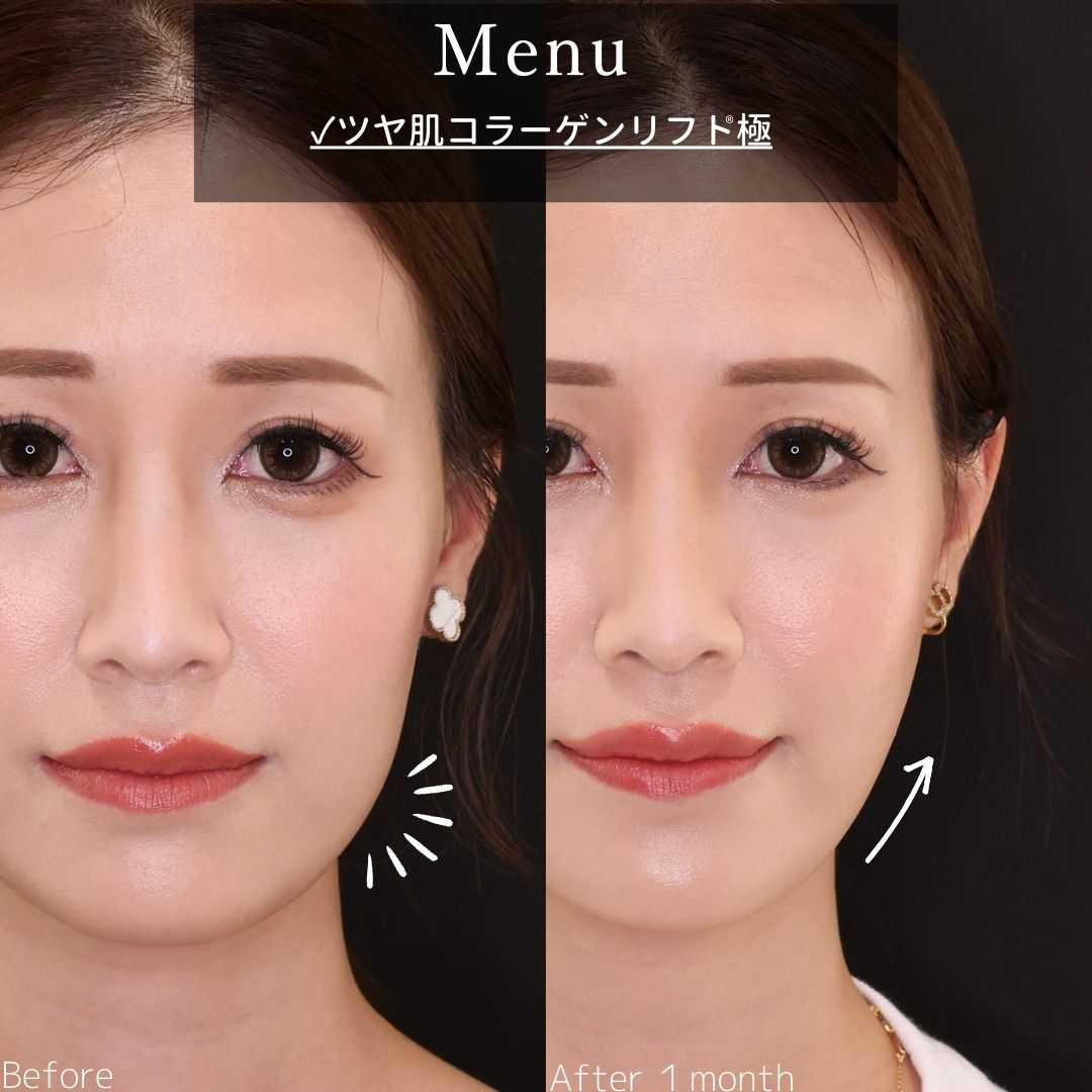 TAC式 ツヤ肌コラーゲンリフト®の症例写真 施術前後 