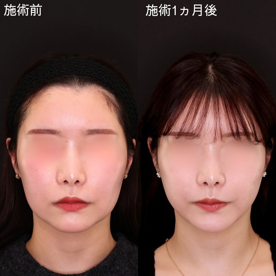 TAC式 ツヤ肌コラーゲンリフト®/ジョールファット除去の症例写真 施術前後