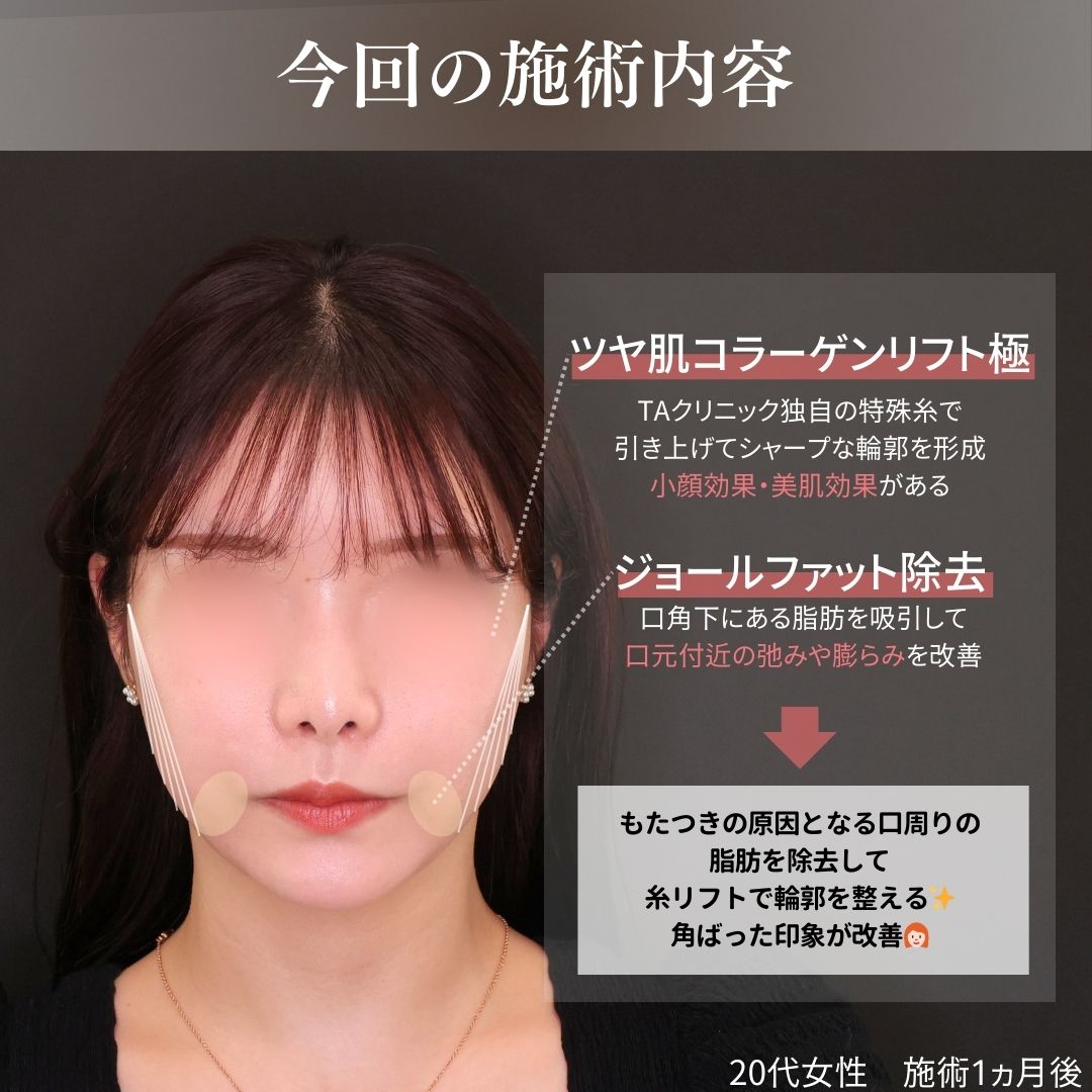 TAC式 ツヤ肌コラーゲンリフト®/ジョールファット除去の症例写真 施術前後