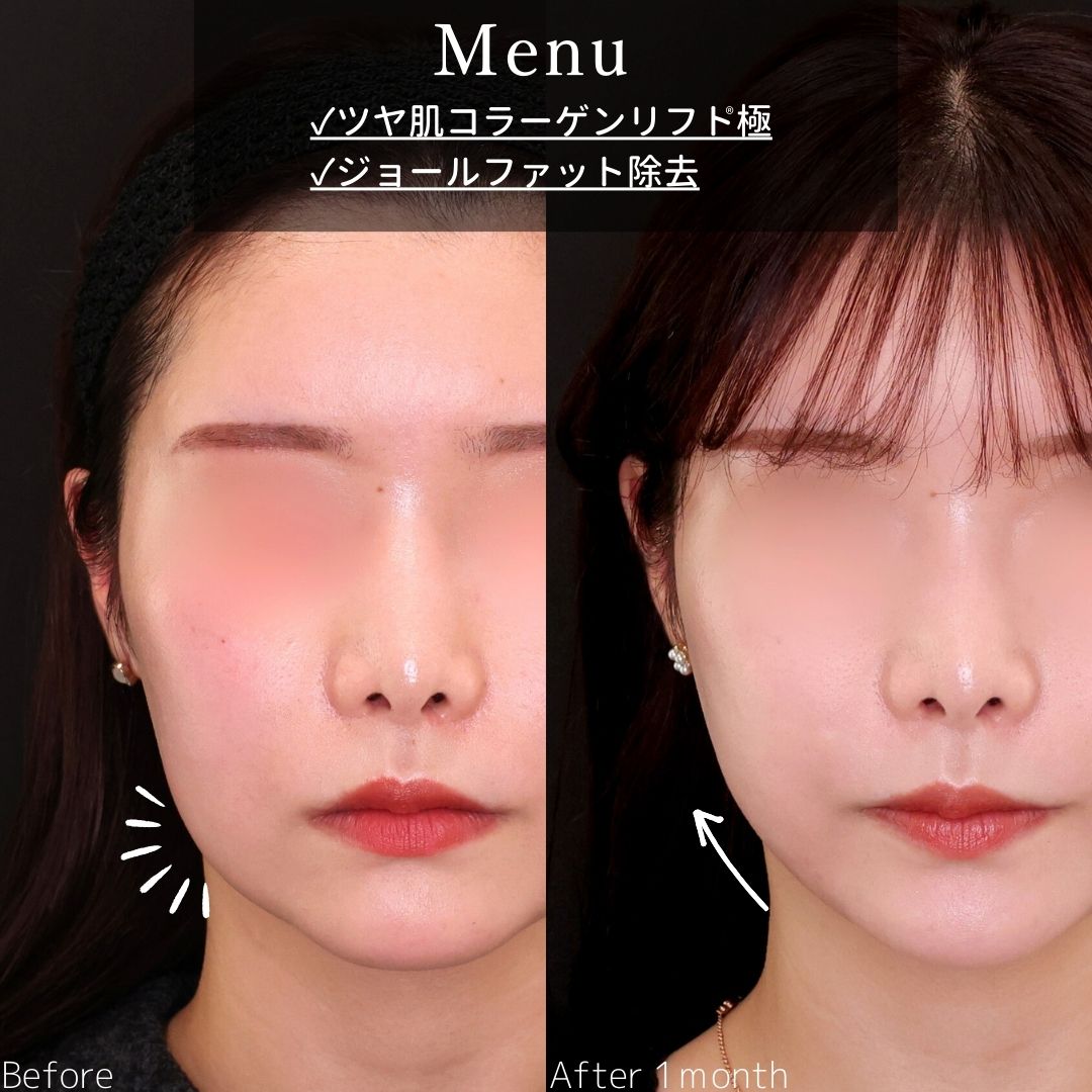 TAC式 ツヤ肌コラーゲンリフト®/ジョールファット除去の症例写真 施術前後