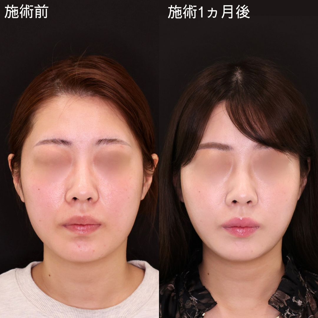 バレない！Dr.石橋の自然な小顔術【糸リフト】