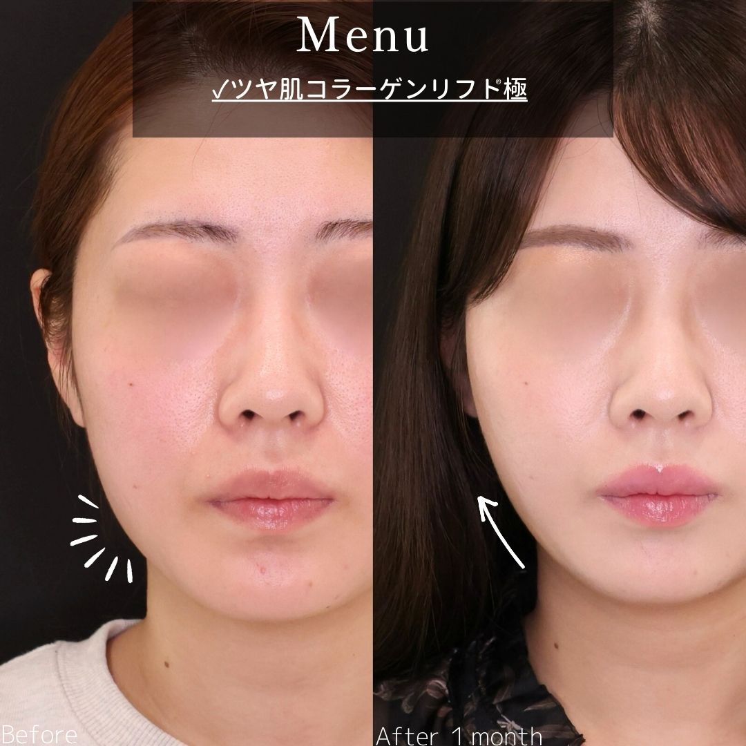 TAC式 ツヤ肌コラーゲンリフト®の症例写真 施術前後 