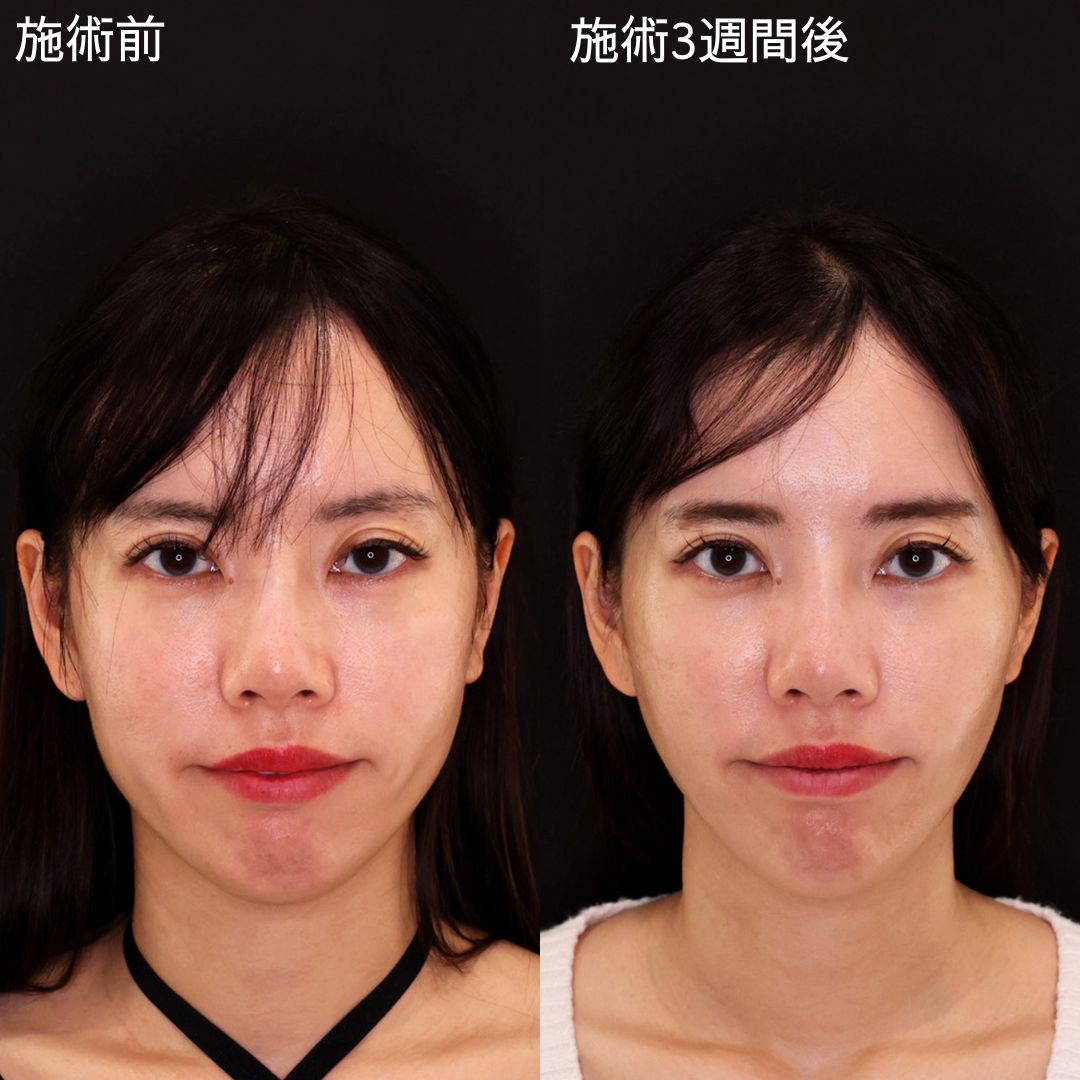 輪郭をシュっと。自然に垢抜け【糸リフトのみ】