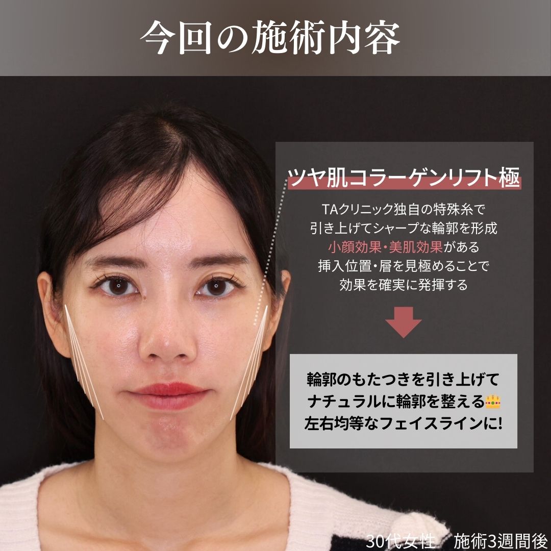 TAC式 ツヤ肌コラーゲンリフト®の症例写真 施術前後 