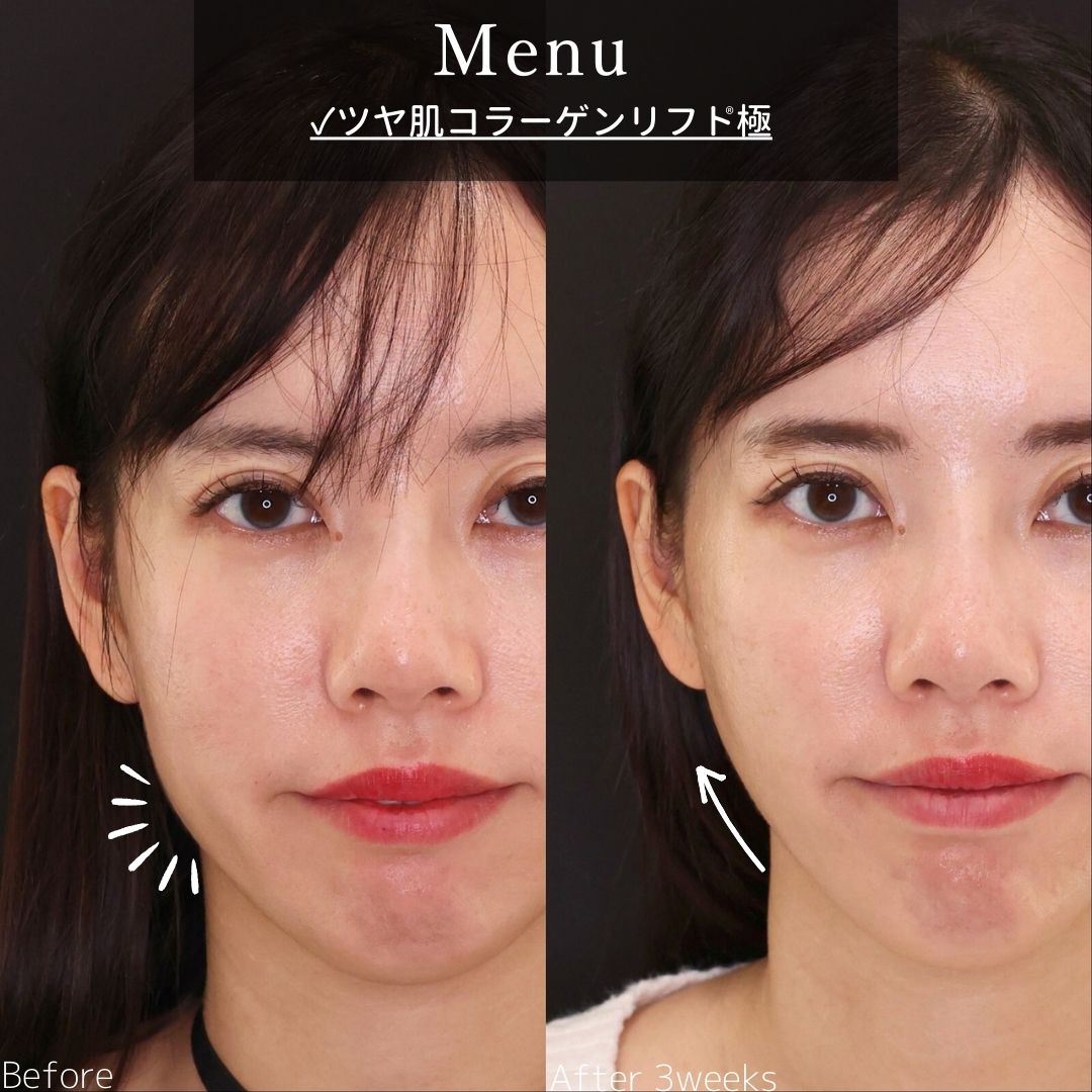 TAC式 ツヤ肌コラーゲンリフト®の症例写真 施術前後 