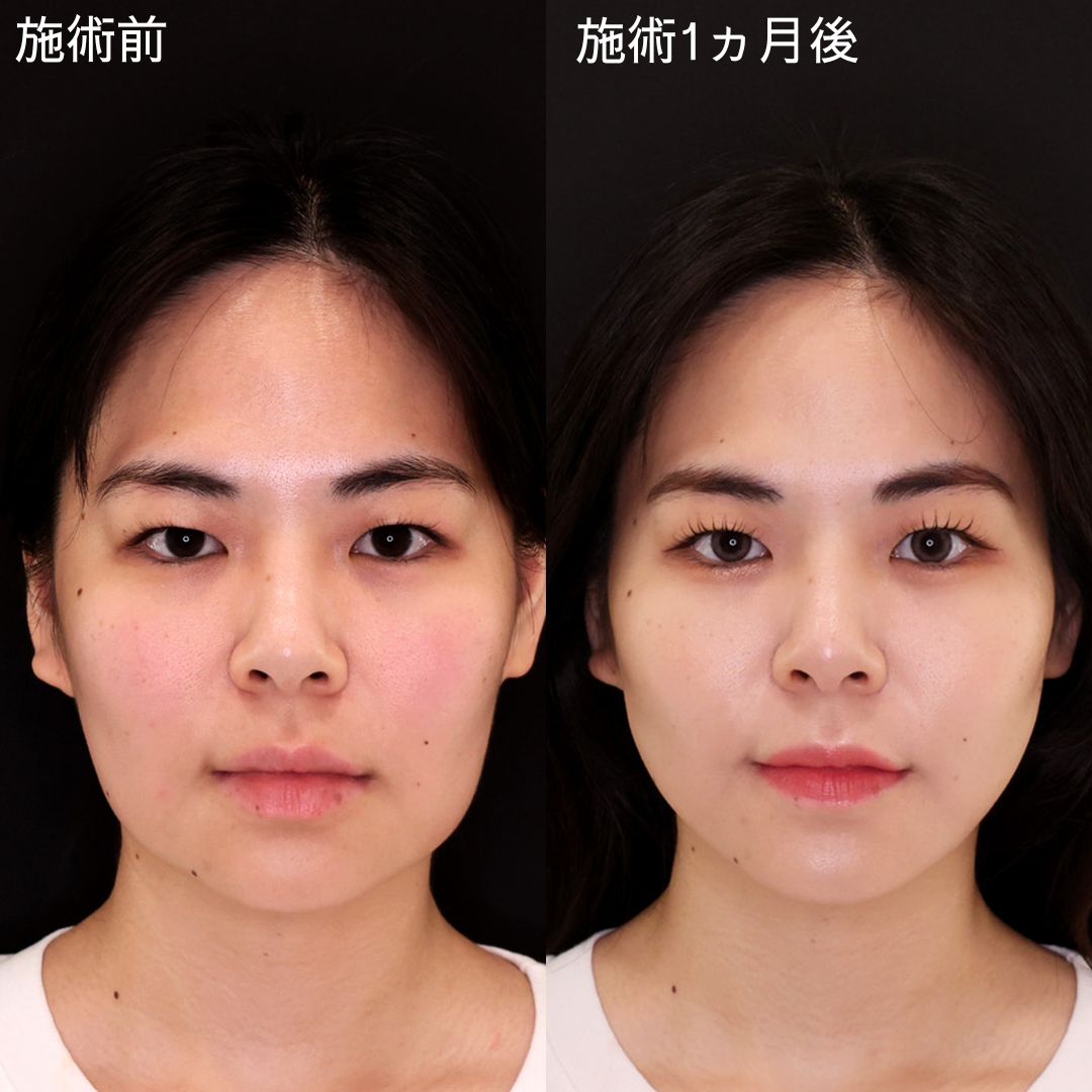 糸リフトだけで輪郭を整える！即日小顔リフト【糸リフト】