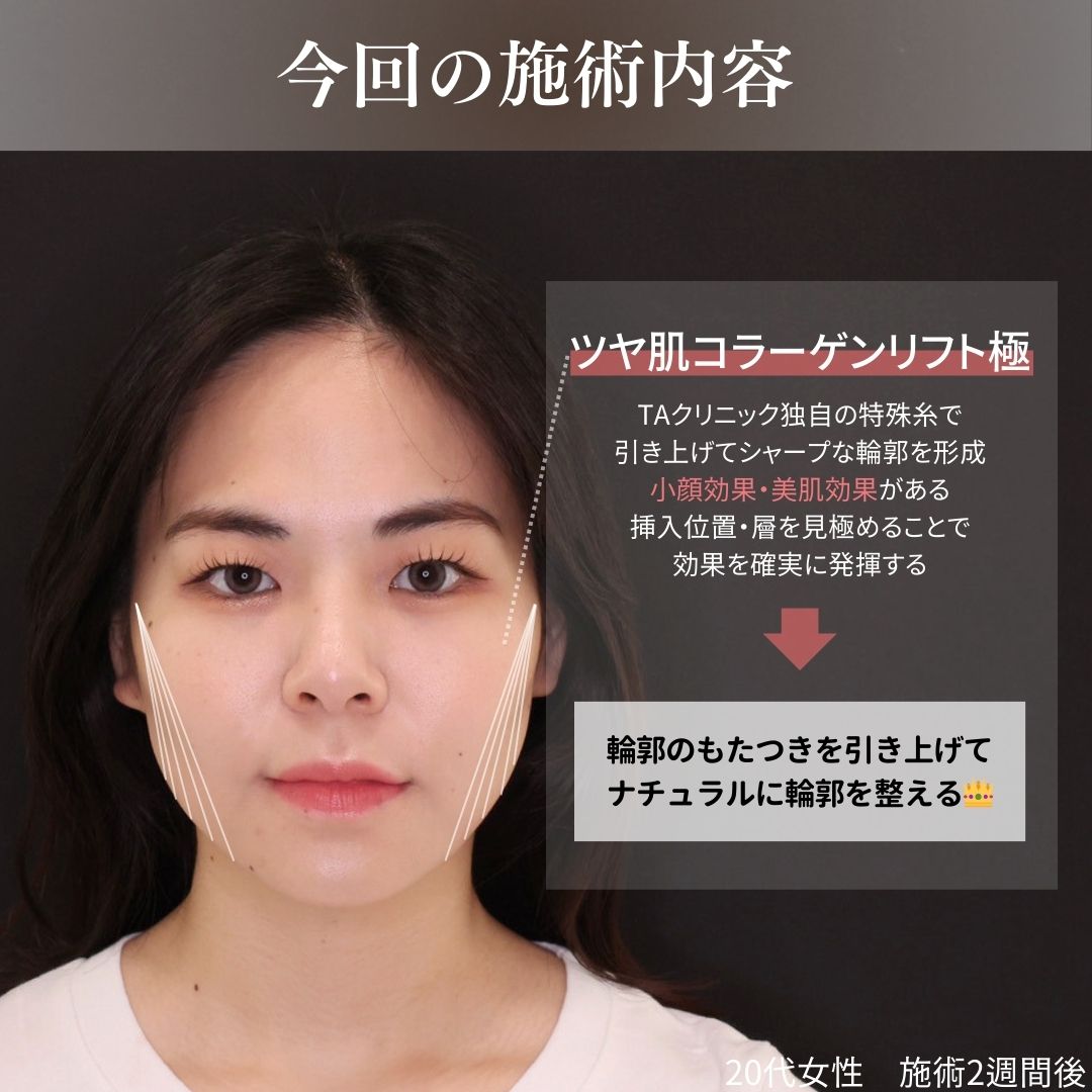 TAC式 ツヤ肌コラーゲンリフト®の症例写真 施術前後 