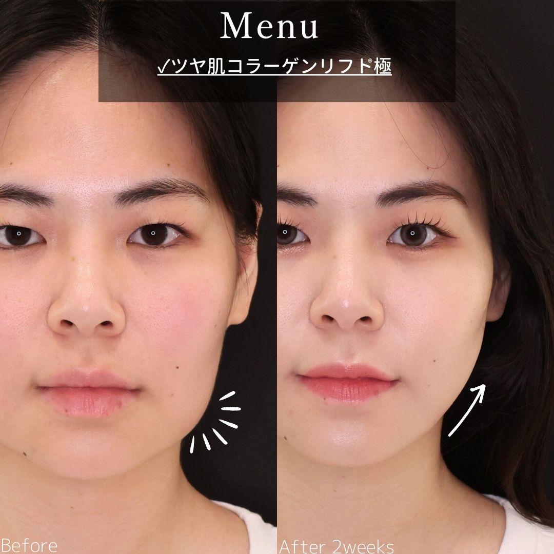 TAC式 ツヤ肌コラーゲンリフト®の症例写真 施術前後 