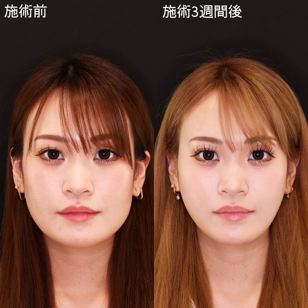 プチ整形で輪郭を整えアプリ級の変化を！【糸リフト】