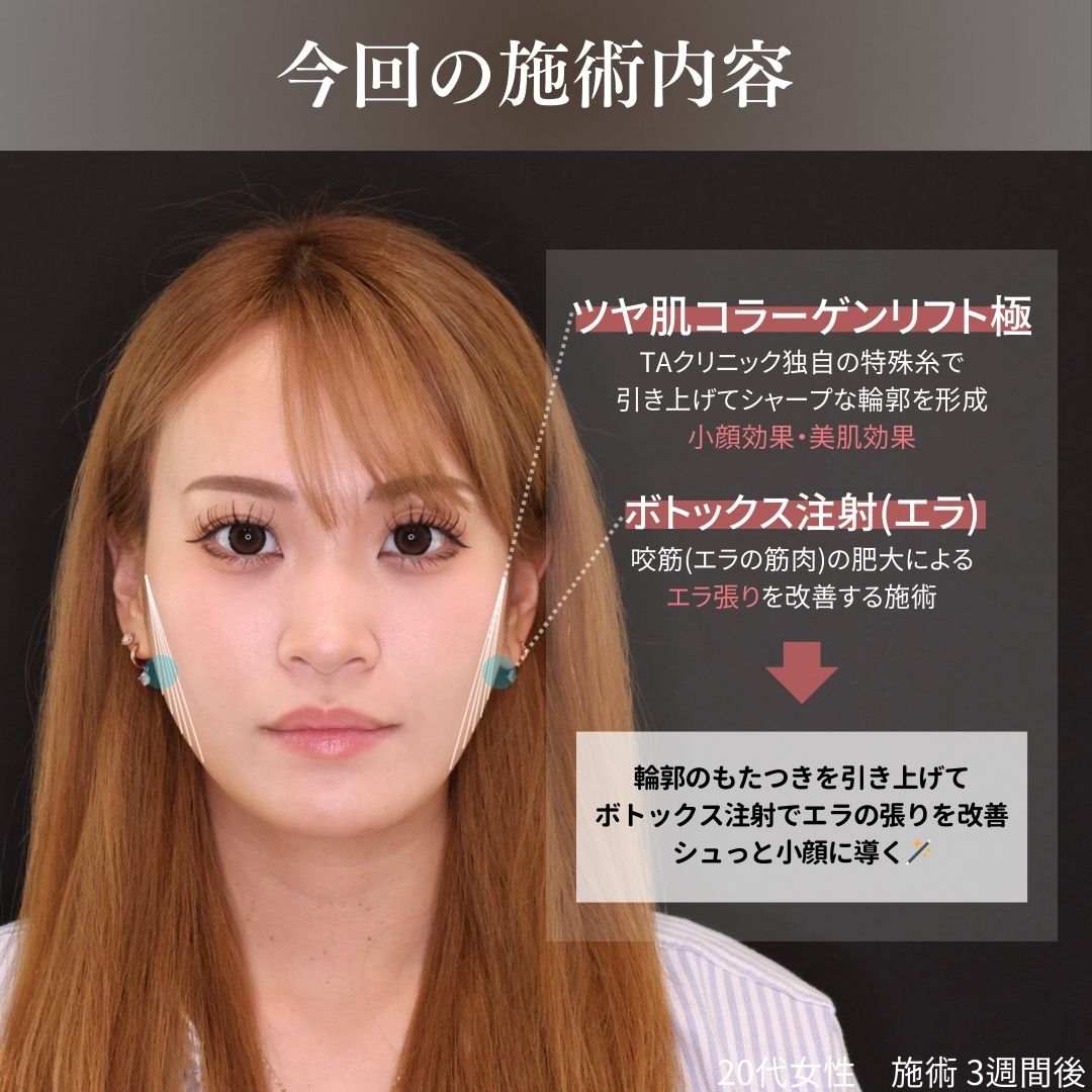 TAC式 ツヤ肌コラーゲンリフト®/エラボトックス注射の症例写真 施術前後 