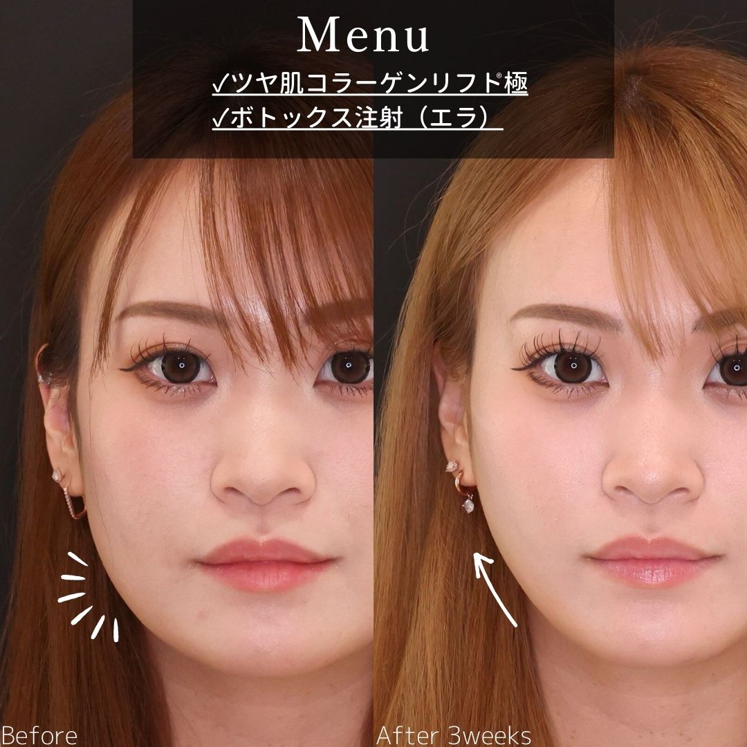 TAC式 ツヤ肌コラーゲンリフト®/エラボトックス注射の症例写真 施術前後 