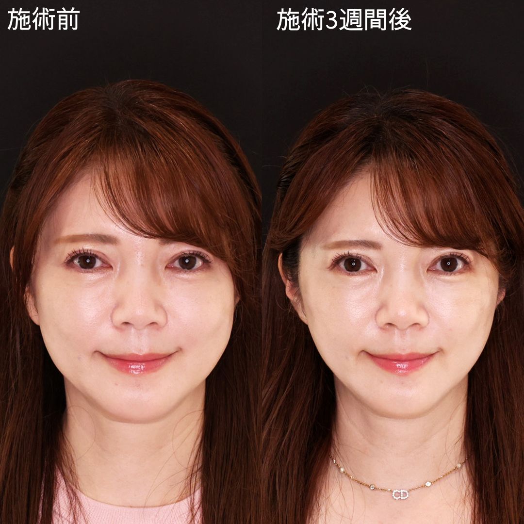TAC式 ツヤ肌コラーゲンリフト®の症例写真 施術前後