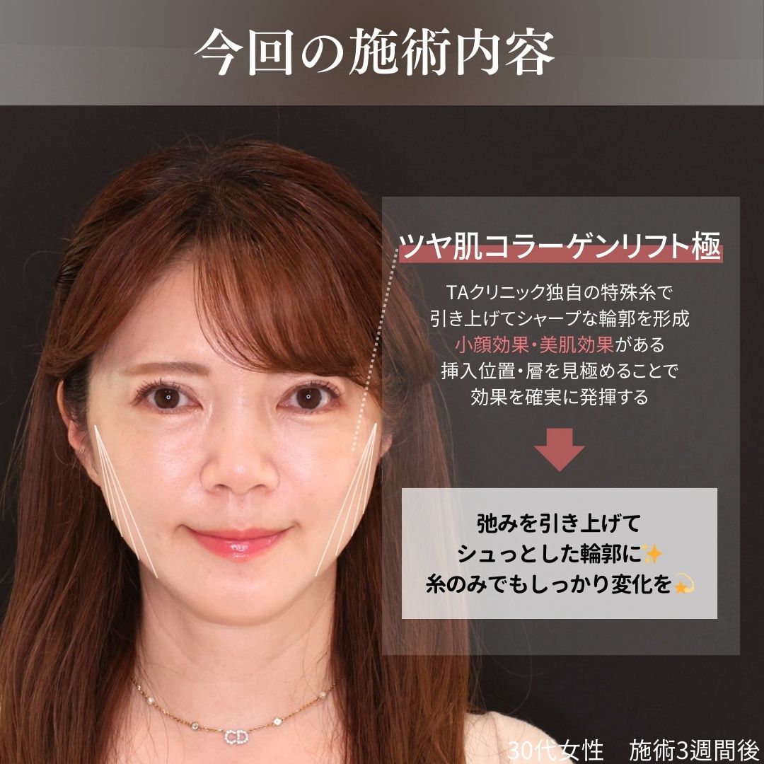 TAC式 ツヤ肌コラーゲンリフト®の症例写真 施術前後