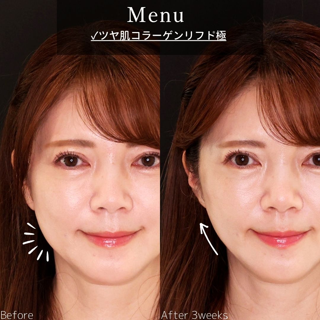 TAC式 ツヤ肌コラーゲンリフト®の症例写真 施術前後