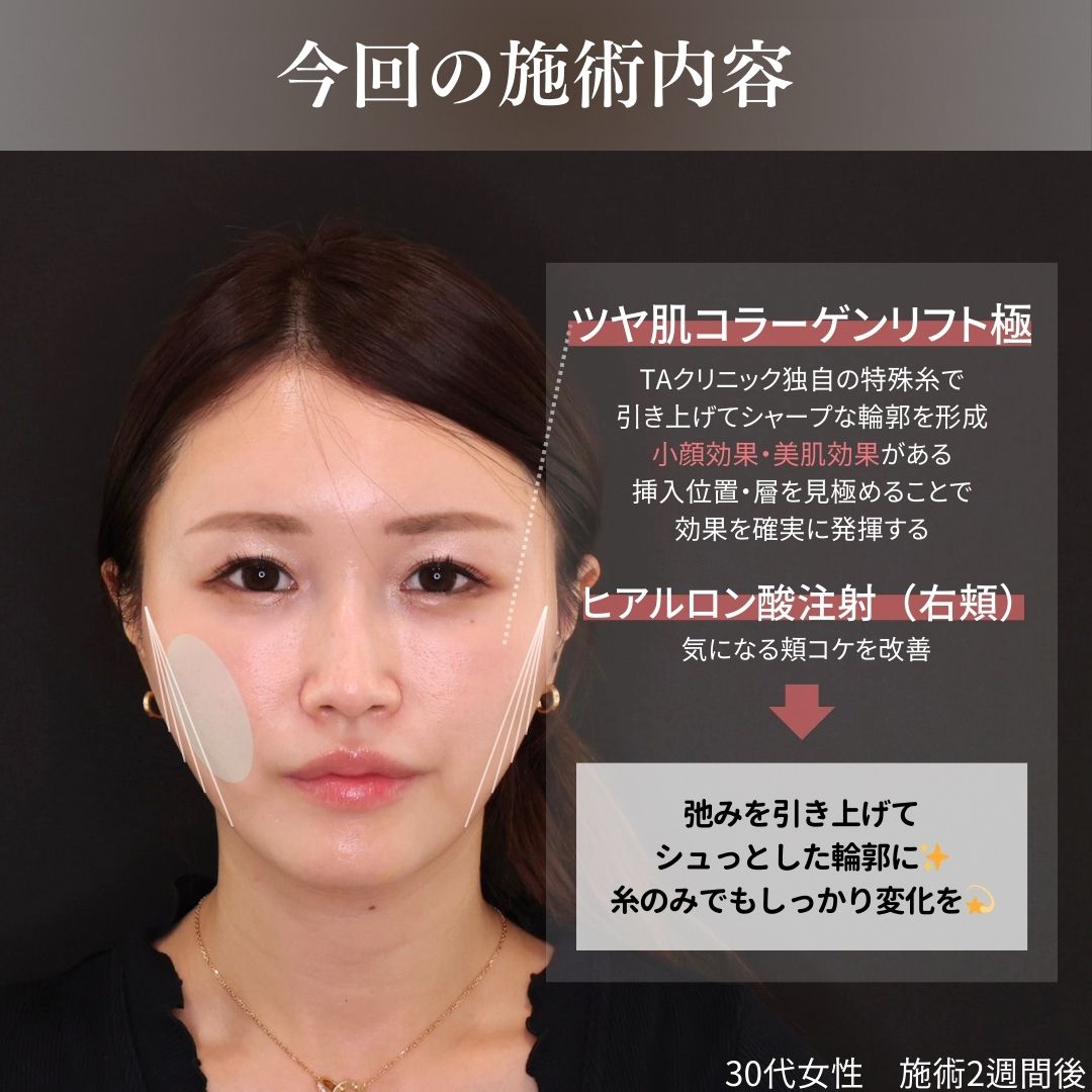 TAC式 ツヤ肌コラーゲンリフト®/ヒアルロン酸注射：その他の症例写真 施術前後 
