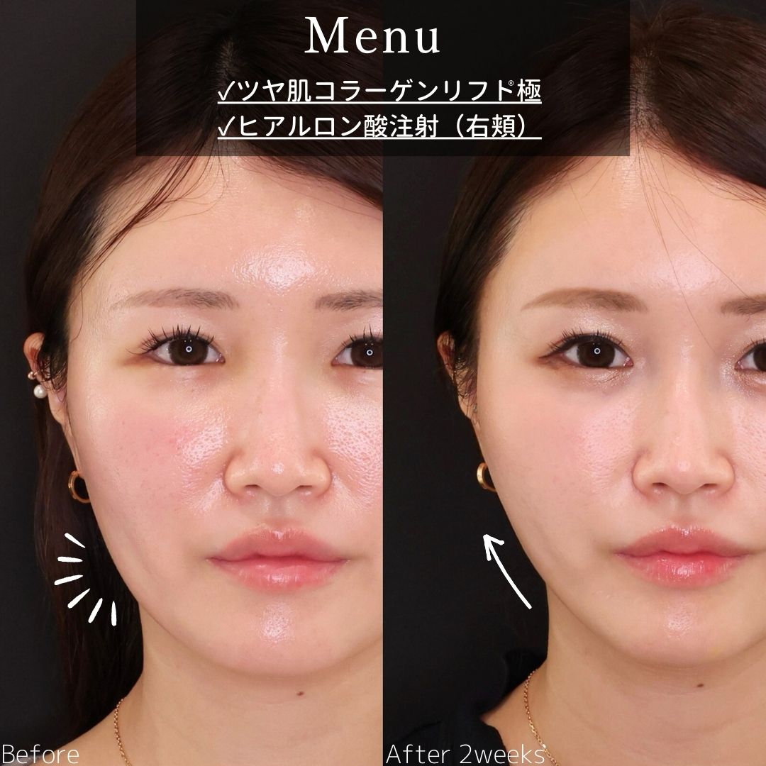 TAC式 ツヤ肌コラーゲンリフト®/ヒアルロン酸注射：その他の症例写真 施術前後 