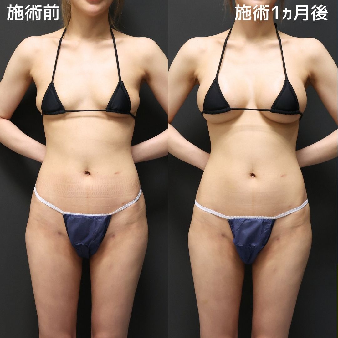 《シリコンバッグ豊胸》ヴァ―ジスラインが美しいバストへ