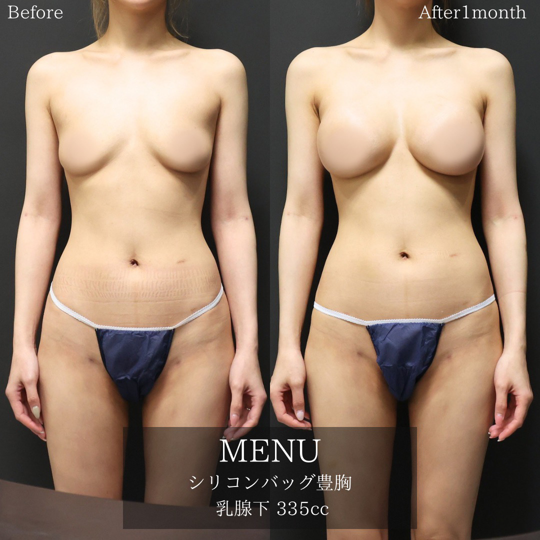 シリコンバッグ豊胸(人工乳腺バッグ)の症例写真 施術前後