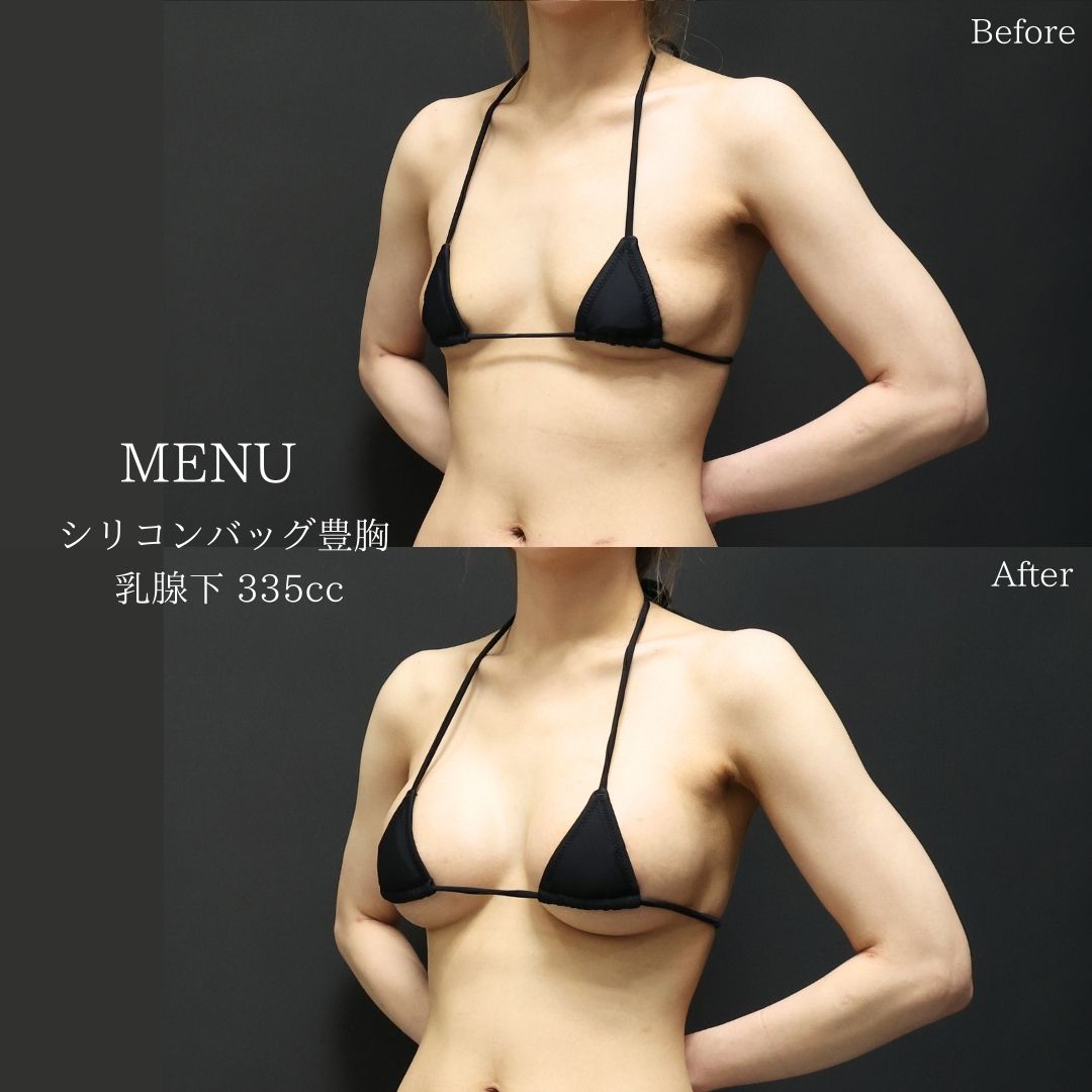 シリコンバッグ豊胸(人工乳腺バッグ)の症例写真 施術前後