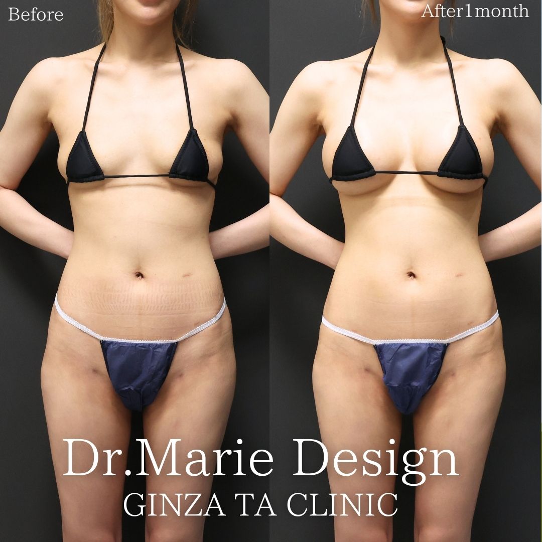 シリコンバッグ豊胸（人工乳腺バッグ）の症例写真 施術前後 