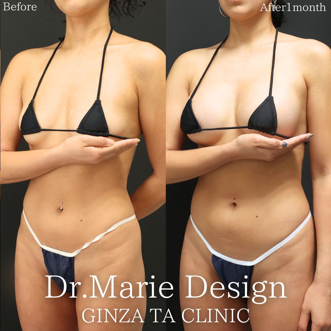 シリコンバッグ豊胸（人工乳腺バッグ）の症例写真 施術前後 