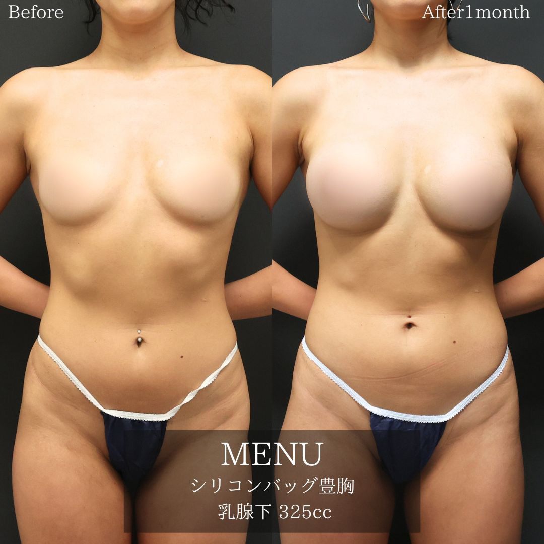 シリコンバッグ豊胸（人工乳腺バッグ）の症例写真 施術前後 