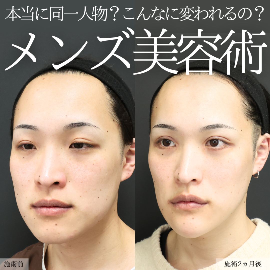 TAC式 ツヤ肌コラーゲンリフト®/Lラインファット除去（エラ下脂肪除去）/下眼瞼脱脂術（目の下のたるみ取り・目の下の脂肪ふくらみ取り）の症例写真 施術前後 