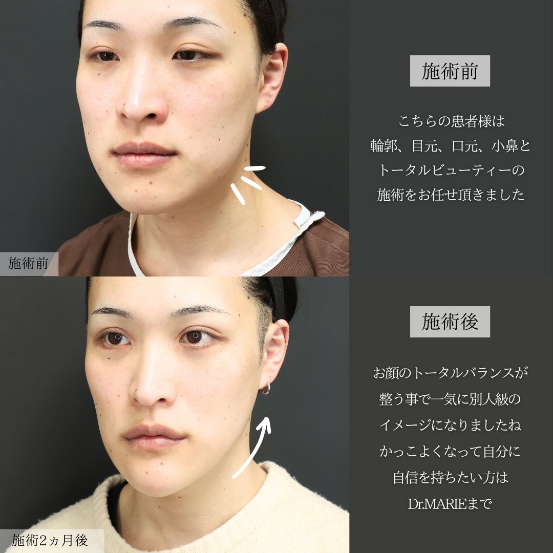 TAC式 ツヤ肌コラーゲンリフト®/Lラインファット除去（エラ下脂肪除去）/下眼瞼脱脂術（目の下のたるみ取り・目の下の脂肪ふくらみ取り）の症例写真 施術前後 