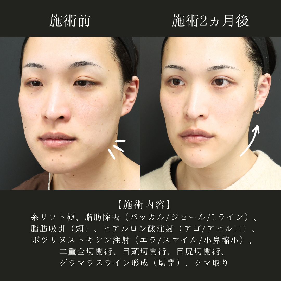 TAC式 ツヤ肌コラーゲンリフト®/Lラインファット除去（エラ下脂肪除去）/下眼瞼脱脂術（目の下のたるみ取り・目の下の脂肪ふくらみ取り）の症例写真 施術前後 