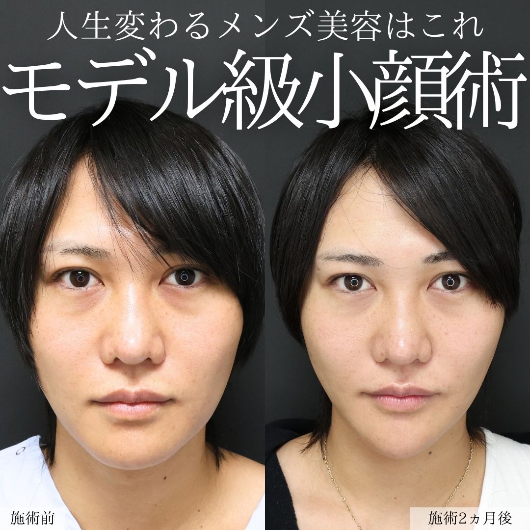 小顔整形｜パーフェクトフェイスライン/顔の脂肪吸引/Lラインファット除去（エラ下脂肪除去）の症例写真 施術前後 