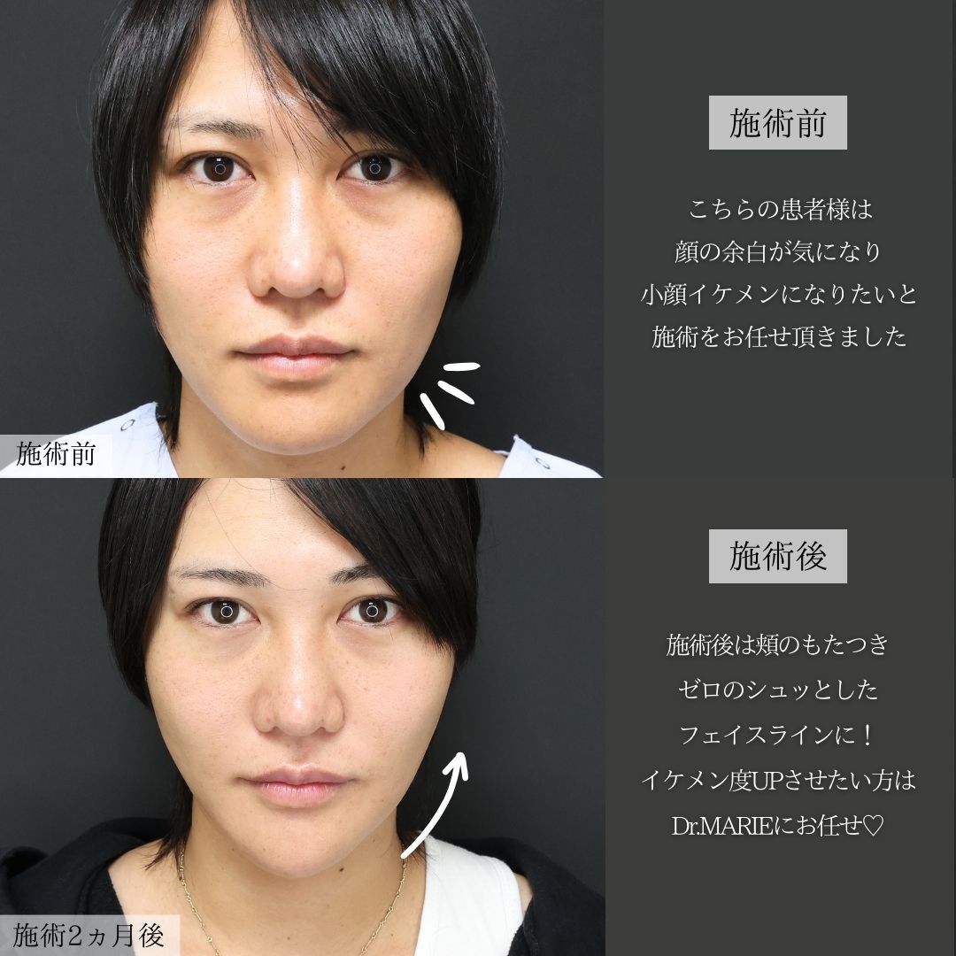 小顔整形｜パーフェクトフェイスライン/顔の脂肪吸引/Lラインファット除去（エラ下脂肪除去）の症例写真 施術前後 