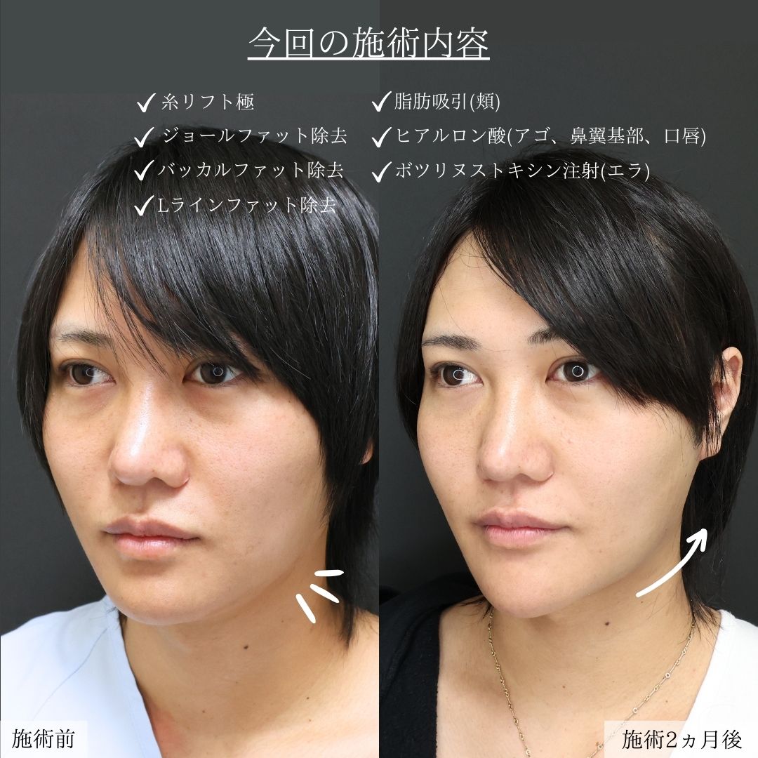 小顔整形｜パーフェクトフェイスライン/顔の脂肪吸引/Lラインファット除去（エラ下脂肪除去）の症例写真 施術前後 