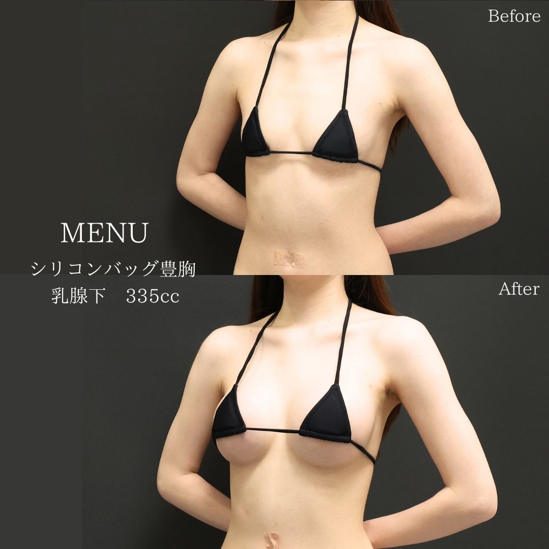 シリコンバッグ豊胸(人工乳腺バッグ)の症例写真 施術前後